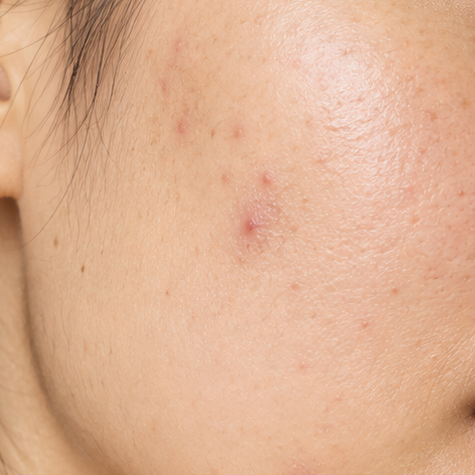 breakouts